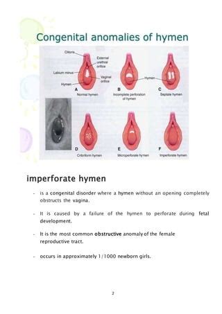 Diagnosis and Management of Hymenal Variants